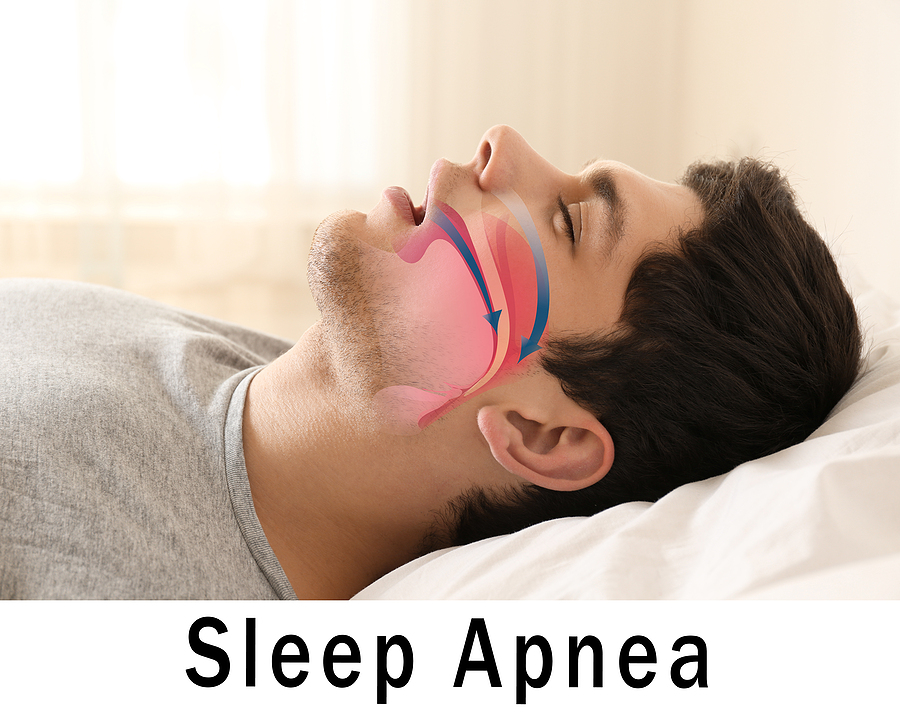 Understanding Obstructive Sleep Apnea in Brooklyn and New York, NY: Causes, Symptoms, and Treatment