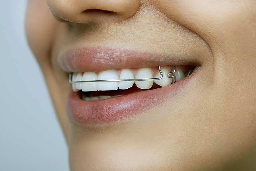 Everything You Need to Know About Retainers in Brooklyn and New York, NY