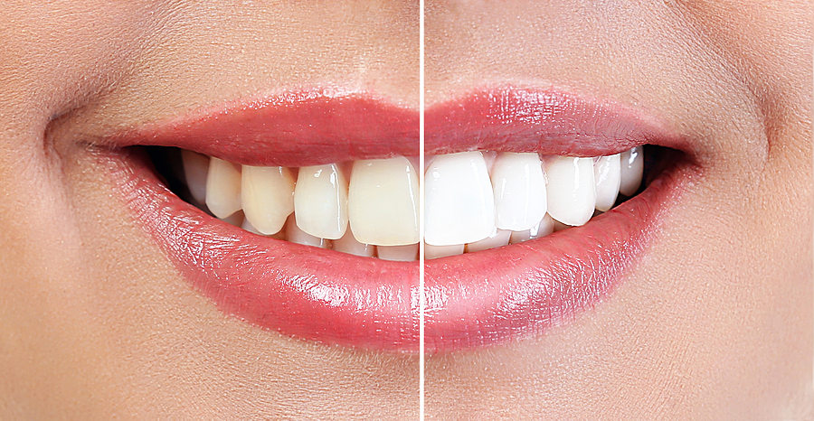Achieve a Radiant Smile with Professional Teeth Whitening in Brooklyn and New York, NY