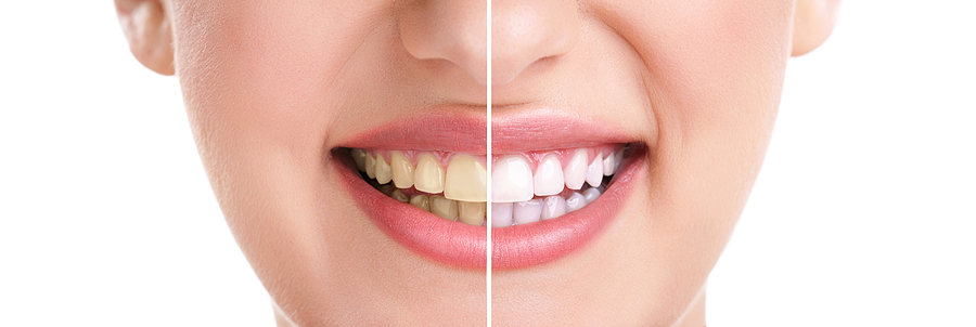 Achieving a Brighter Smile: The Ultimate Guide to Teeth Whitening in New York, NY