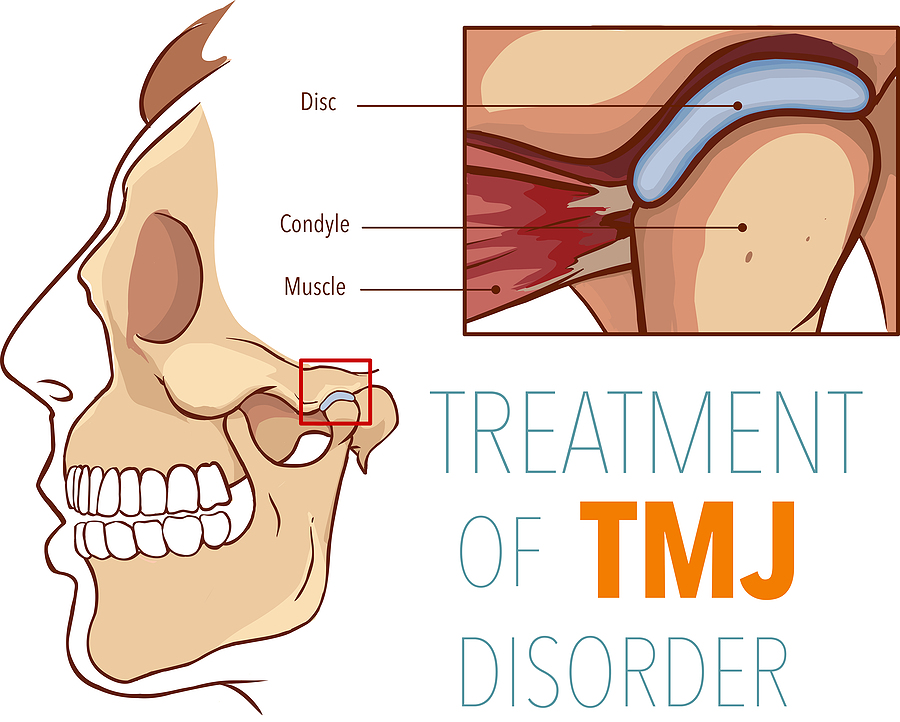 Understanding TMJ-TMD: Causes, Symptoms, and Treatment Options in Brooklyn and New York, NY