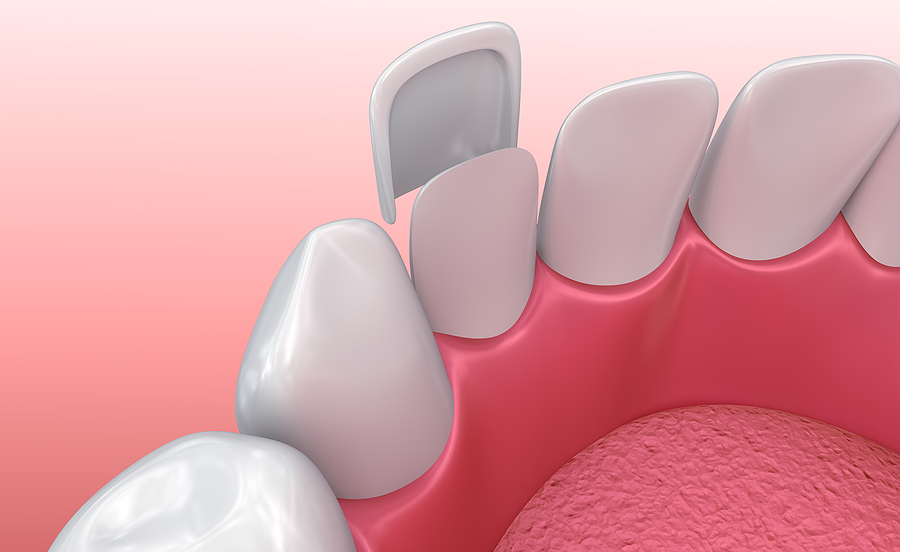 Transform Your Smile with Veneers in Brooklyn and New York, NY
