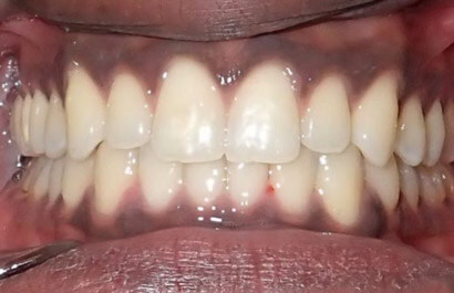 https://www.dentalspecialistsofny.com/wp-content/uploads/2026/03/ba-gallery-after11.jpg