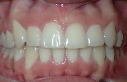 https://www.dentalspecialistsofny.com/wp-content/uploads/2026/03/ba-gallery-after12.jpg