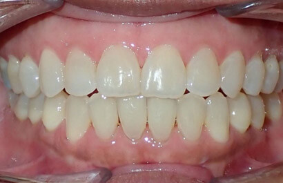 https://www.dentalspecialistsofny.com/wp-content/uploads/2026/03/ba-gallery-after13.jpg