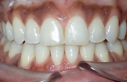 https://www.dentalspecialistsofny.com/wp-content/uploads/2026/03/ba-gallery-after14.jpg