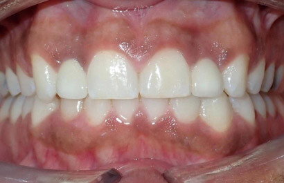 https://www.dentalspecialistsofny.com/wp-content/uploads/2026/03/ba-gallery-after15.jpg
