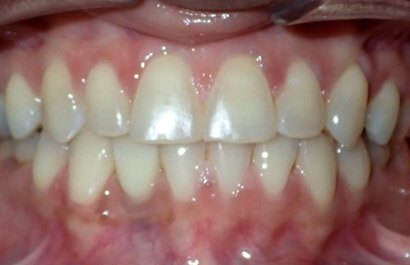 https://www.dentalspecialistsofny.com/wp-content/uploads/2026/03/ba-gallery-after18.jpg
