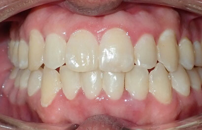 https://www.dentalspecialistsofny.com/wp-content/uploads/2026/03/ba-gallery-after19.jpg