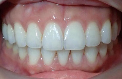 https://www.dentalspecialistsofny.com/wp-content/uploads/2026/03/ba-gallery-after6.jpg