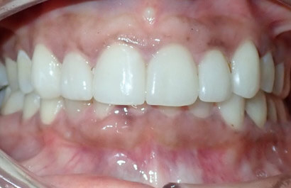 https://www.dentalspecialistsofny.com/wp-content/uploads/2026/03/ba-gallery-after7.jpg
